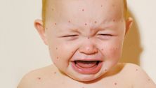 What you need to know about the chicken pox vaccine