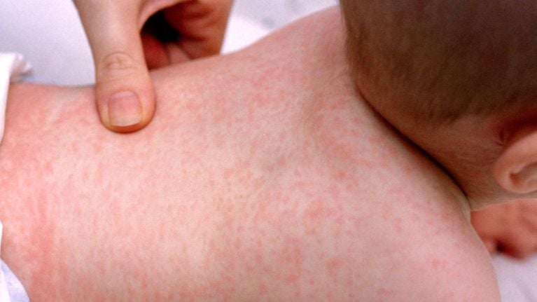 10 Common Rashes on Kids (with photos): Symptoms and Treatment
